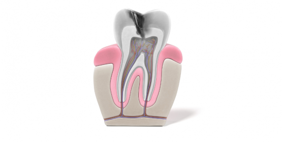 Endodoncia