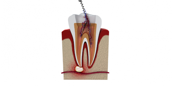 Endodoncia rotatoria