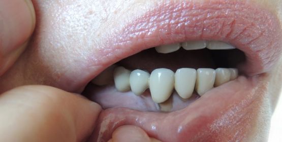 Periodontitis